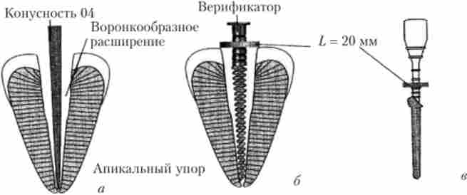   ,  Thermafil [27]